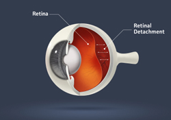 Retinal Detachment